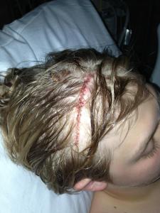 The stitches and incision site from my neurosurgery.