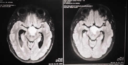 In this picture you can see the first MRI (left) from right before my surgery. In that picture the fluid pools were much too big and that's why during my surgery the surgeon opened up a place for the fluid to drain. In the MRI from back in July (right) you can see that the fluid was draining really well. 