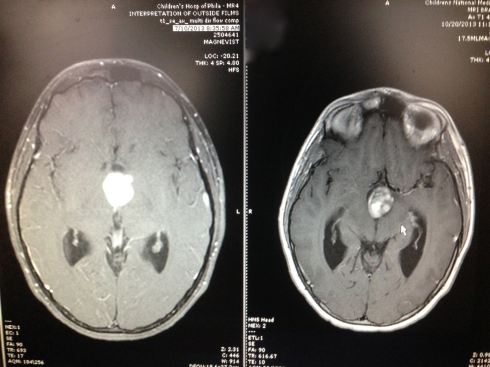 This is a comparison of my MRI from July (left) and my MRI from Sunday (right). As you can see, the MRI from Sunday shows the tumor has actually shrunk (2mm) and the change in coloration shows that it's dying. However, in this image you can see how the fluid pools are starting to fill up again.