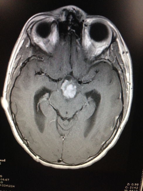 Finally, one last photo of Eugene the brain-tumor!