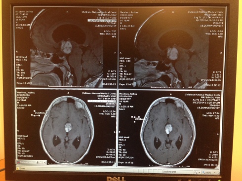 Photo comparing Eugene from one MRI to the next.